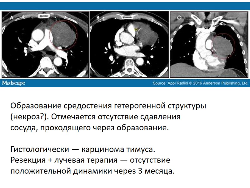 Образование средостения гетерогенной структуры (некроз?). Отмечается отсутствие сдавления сосуда, проходящего через образование.  Гистологически